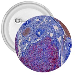 Histology Inc Histo Logistics Incorporated Human Liver Rhodanine Stain Copper 3  Buttons