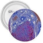 Histology Inc Histo Logistics Incorporated Human Liver Rhodanine Stain Copper 3  Buttons Front