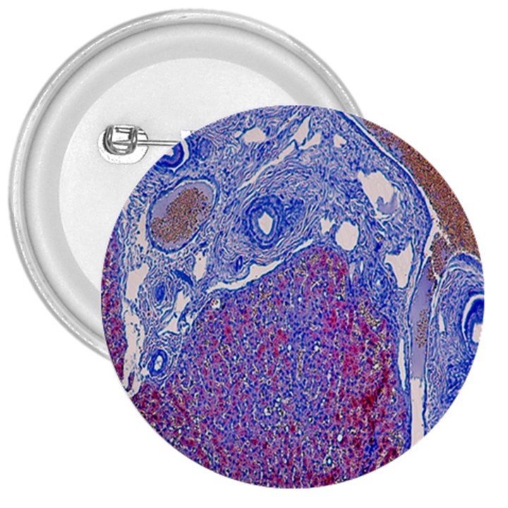 Histology Inc Histo Logistics Incorporated Human Liver Rhodanine Stain Copper 3  Buttons